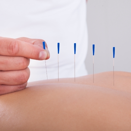 dry-needling-Health-Shift-MN-WI